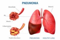 Pengertian Pneumonia dan penyebabnya